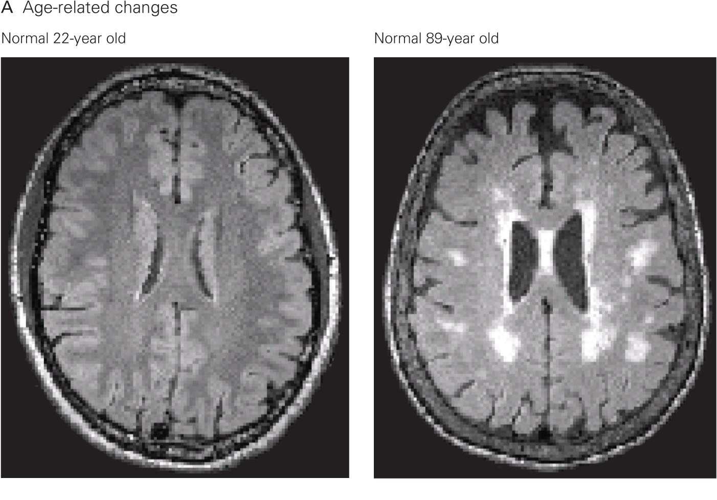 The Aging Brain | Neupsy Key