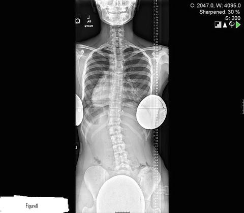 Radiographic Evaluation Of Suspected Scoliosis | Neupsy Key