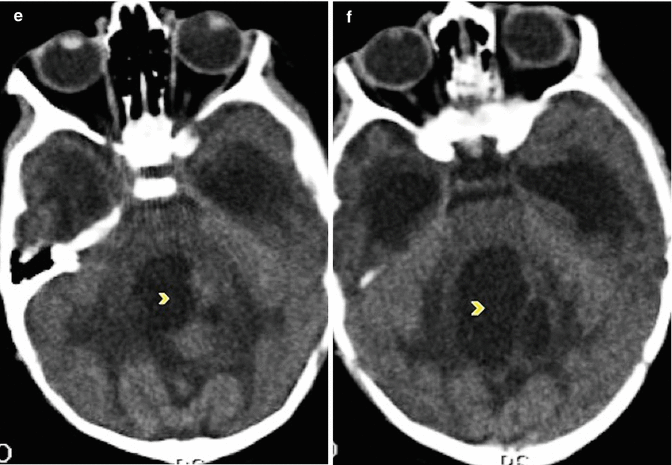 Imaging Of Medulloblastoma Neupsy Key