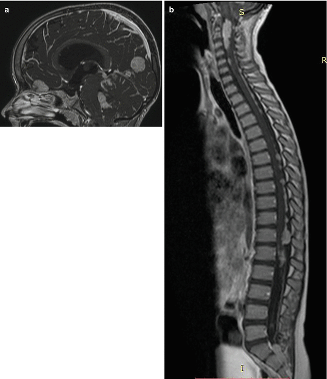 Medulloblastoma: Surgery | Neupsy Key