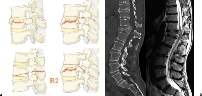 Burst Fracture Treatment | Neupsy Key