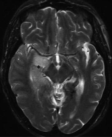 Neuroimaging In Status Epilepticus | Neupsy Key