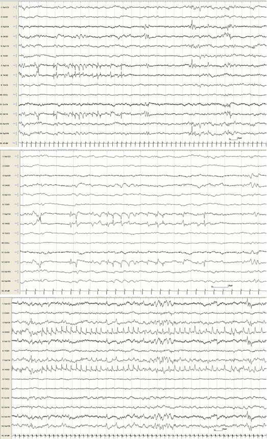 Electrographic Seizures In Pediatrics: Recognition And Examples ...