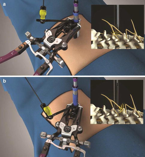 Lateral Transpsoas Retractor Technology | Neupsy Key