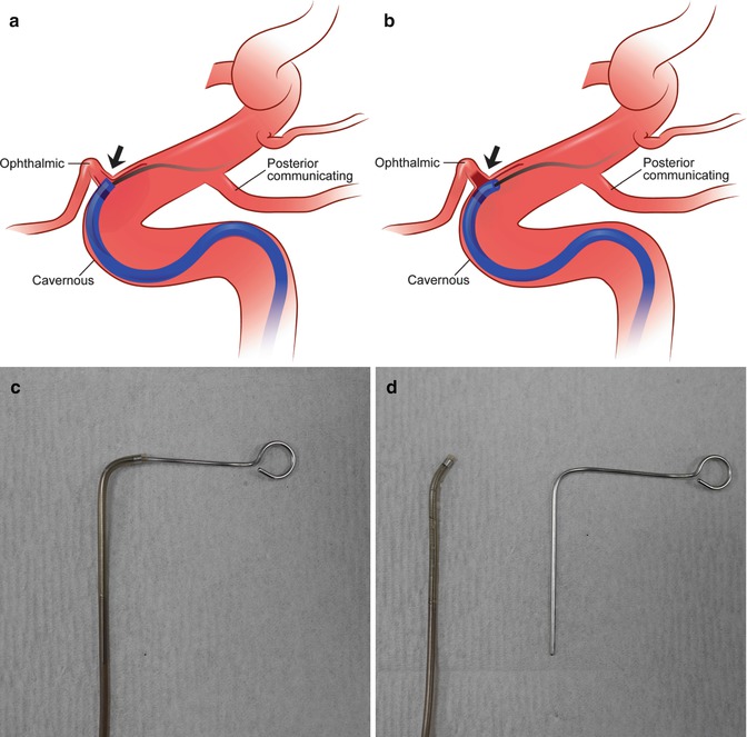 Clot Aspiration Thrombectomy In Acute Ischemic Stroke | Neupsy Key