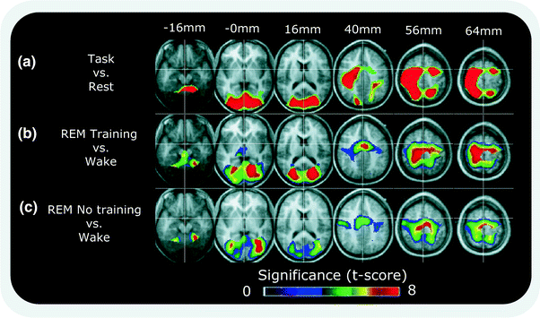 Sleep And Memory Consolidation | Neupsy Key