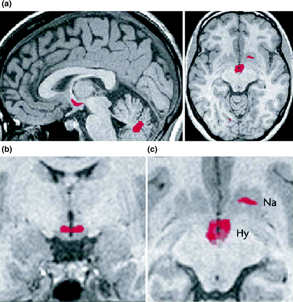 Neuroimaging In Normal And Abnormal Sleep | Neupsy Key