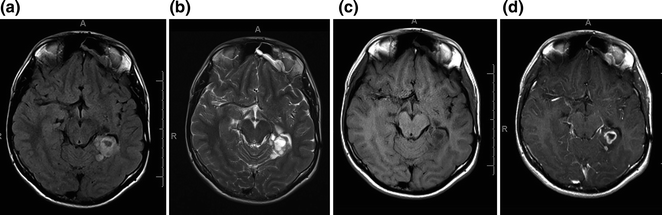 Neuroimaging In Epilepsy | Neupsy Key