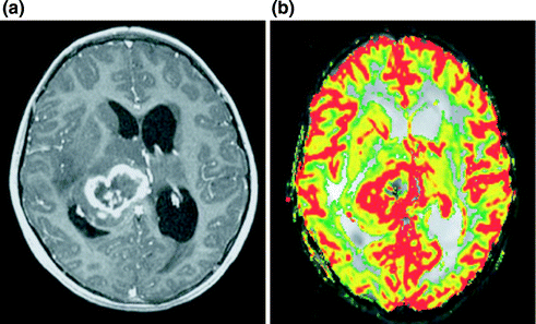 Neuroimaging In Epilepsy | Neupsy Key