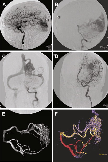 Diagnosis And Management Of Arteriovenous Malformations In Children ...