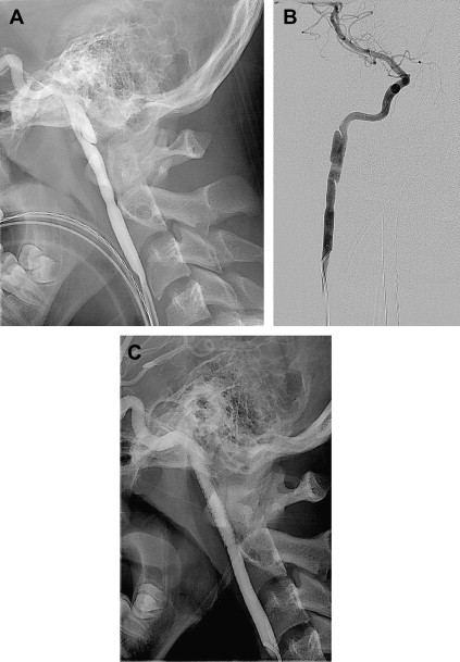 Traumatic Intracranial And Extracranial Vascular Injuries In Children ...