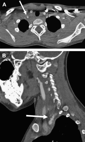 Traumatic Intracranial And Extracranial Vascular Injuries In Children ...