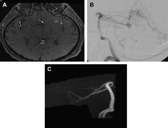 Selection Of Treatment Modalities Or Observation Of Arteriovenous ...