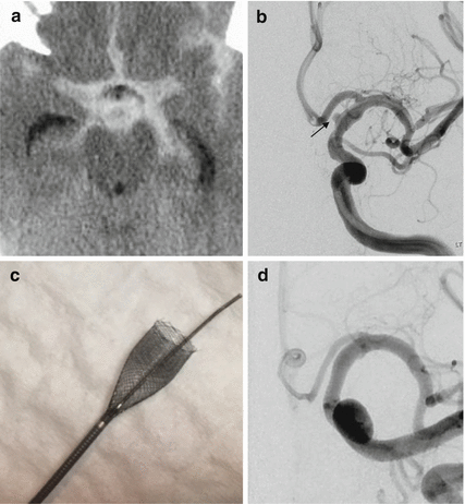 Aneurysmal Subarachnoid Hemorrhage | Neupsy Key