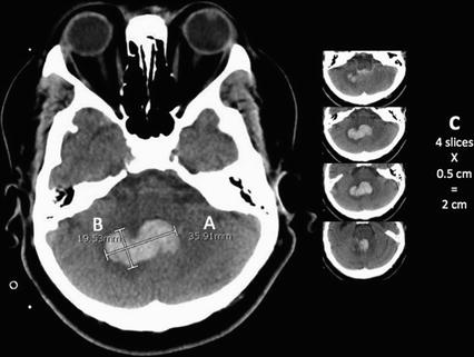 Intracerebral Hemorrhage | Neupsy Key