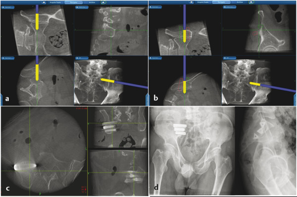 Sacroiliac Joint Fusion Indications And Techniques | Neupsy Key