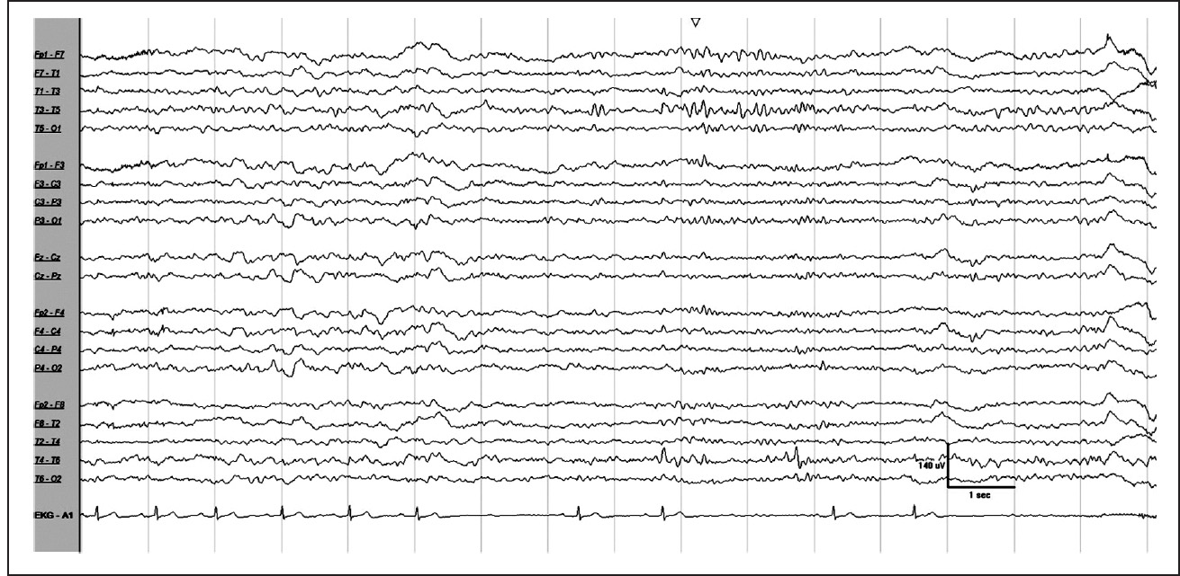 Instrumentation and Polygraphic EEG | Neupsy Key