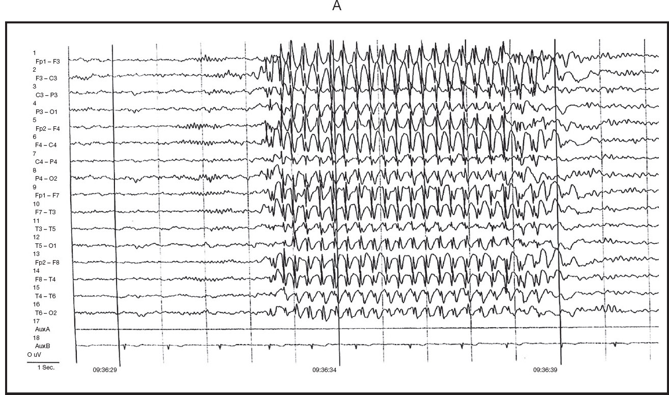 Clinical Use of Ambulatory EEG in Adults | Neupsy Key