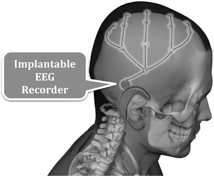 Future Directions In Ambulatory EEG | Neupsy Key