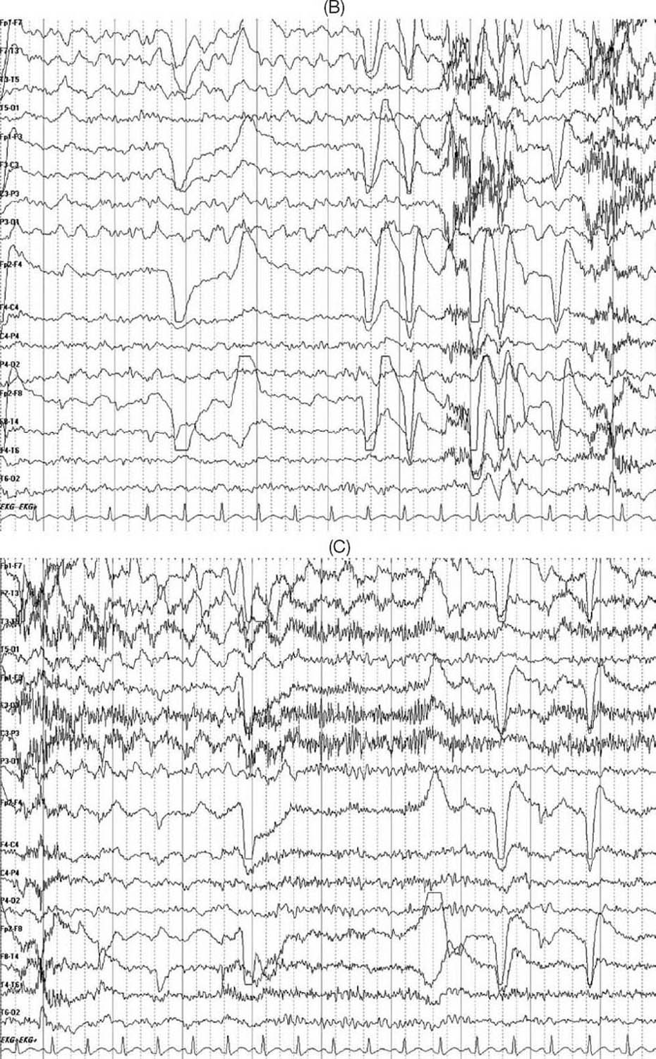 Ambulatory EEG Cases | Neupsy Key