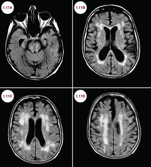 Ischemia | Neupsy Key