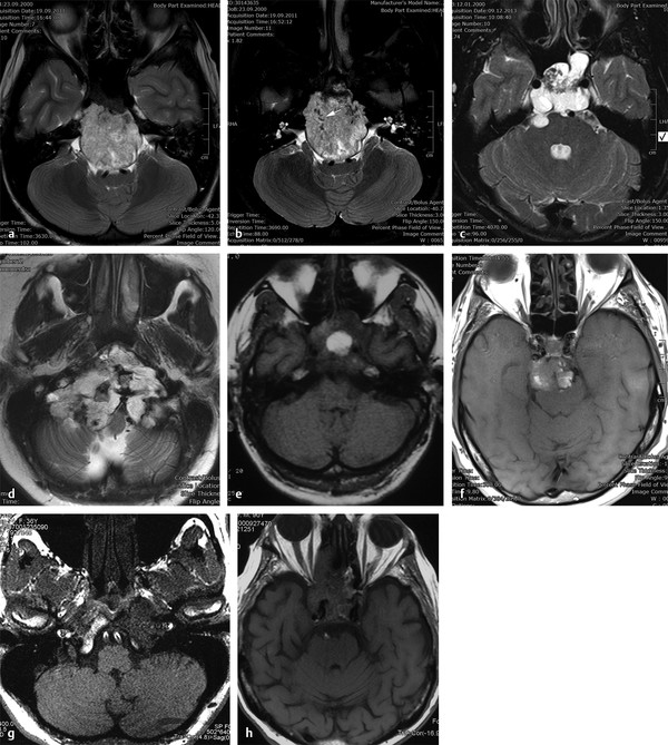 Radiologic Findings And Differential Diagnosis Of Chordomas At The ...