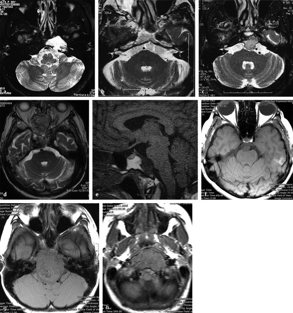 Radiologic Findings And Differential Diagnosis Of Chordomas At The ...