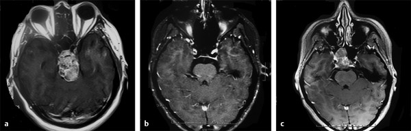 Recurrence In Skull Base Chordomas And Its Management | Neupsy Key