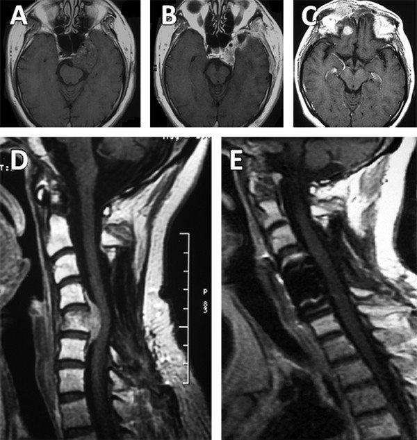 Recurrence In Skull Base Chordomas And Its Management | Neupsy Key