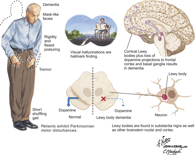 Dementia With Lewy Bodies (Including Parkinson’s Disease Dementia ...