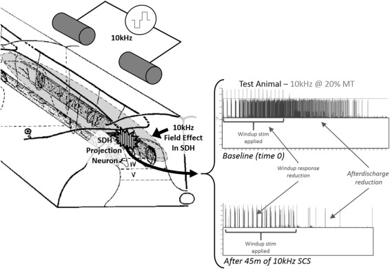 Spinal Cord Stimulation: Mechanisms Of Action | Neupsy Key