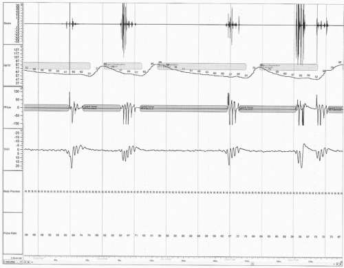 Home Sleep Apnea Monitoring | Neupsy Key