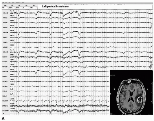 Focal EEG Abnormalities | Neupsy Key