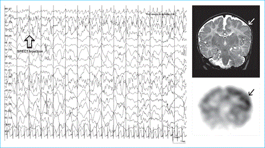 Epileptic Encephalopathy | Neupsy Key