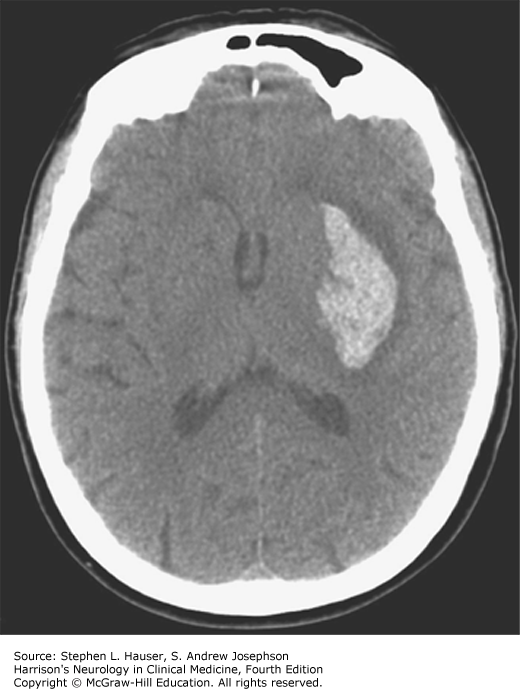 CEREBROVASCULAR DISEASES | Neupsy Key