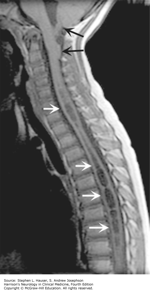 DISEASES OF THE SPINAL CORD | Neupsy Key