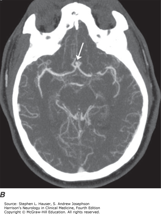 NEUROIMAGING IN NEUROLOGIC DISORDERS | Neupsy Key