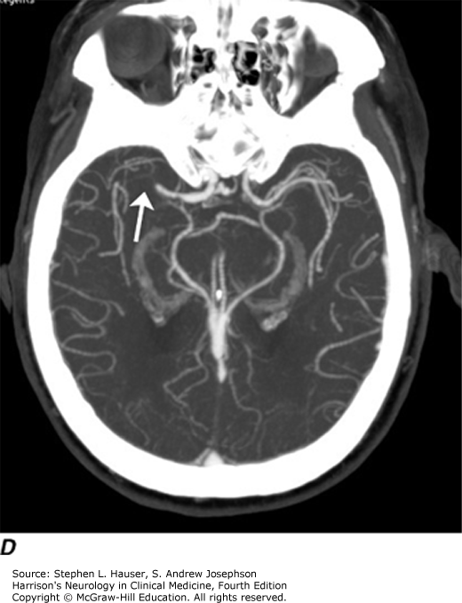 NEUROIMAGING IN NEUROLOGIC DISORDERS | Neupsy Key