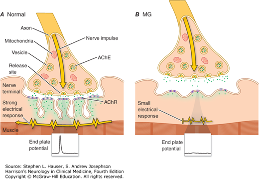 MYASTHENIA GRAVIS AND OTHER DISEASES OF THE NEUROMUSCULAR JUNCTION ...