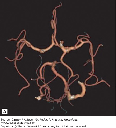 Neuroimaging In The Management Of Neurological Disease | Neupsy Key