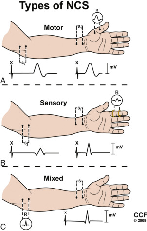 Electrodiagnostic Studies | Neupsy Key