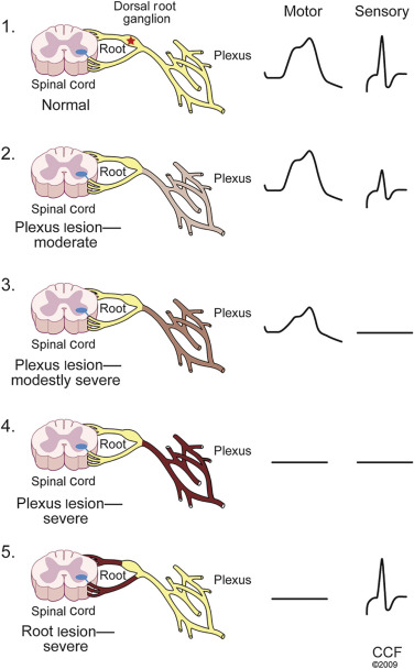 Electrodiagnostic Studies | Neupsy Key