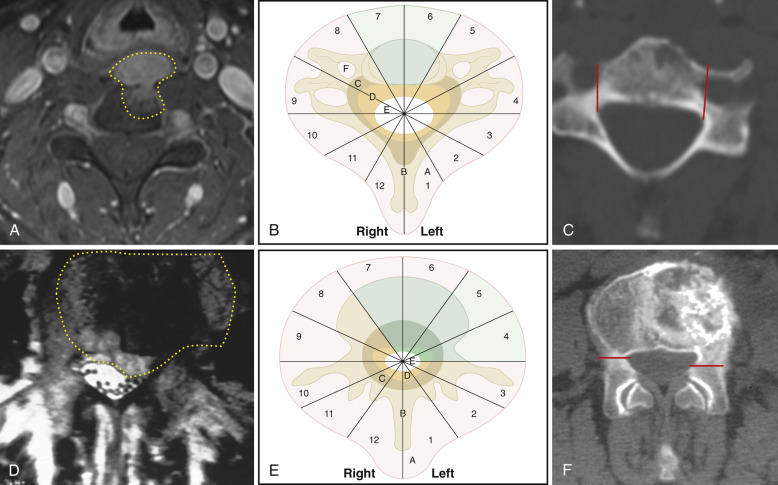 Preoperative Planning, Staging, Oncologic Approaches, And Outcomes For ...