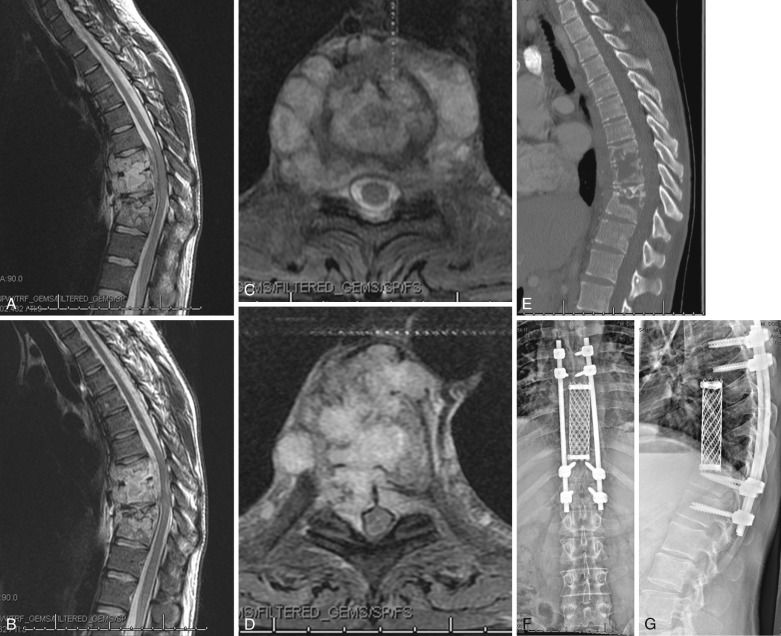 Spinal Infections: Diagnosis And Treatment Of Discitis, Osteomyelitis ...