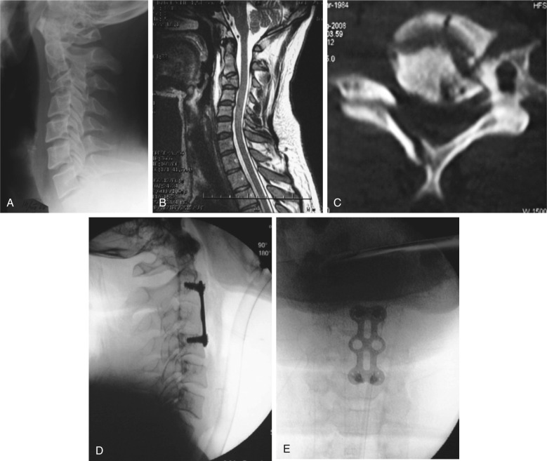 Subaxial Cervical Spine Injuries | Neupsy Key