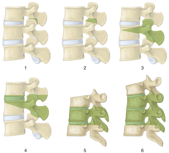 Osteotomies For The Correction Of Deformities | Neupsy Key