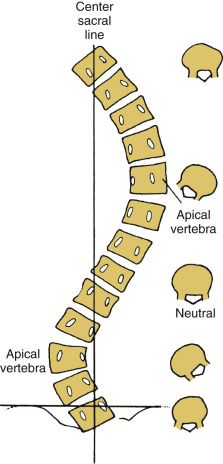 Pediatric Spinal Deformities And Deformity Correction | Neupsy Key