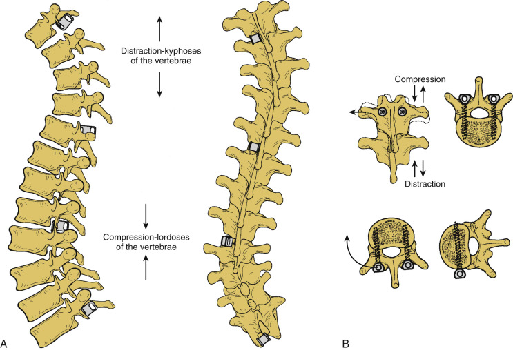 Pediatric Spinal Deformities And Deformity Correction | Neupsy Key