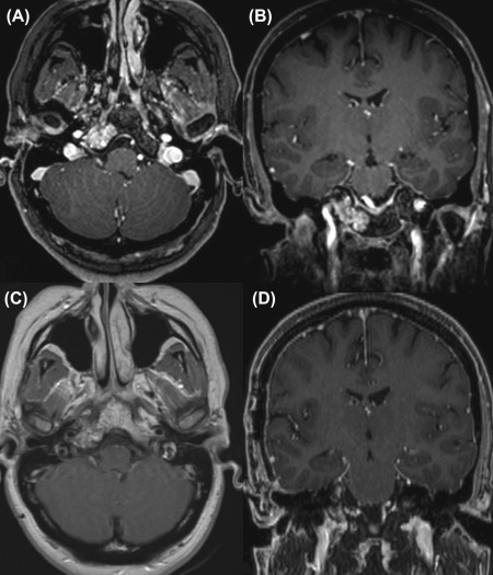 Staged Approaches For Large Skull Base Chordomas And Chondrosarcomas ...