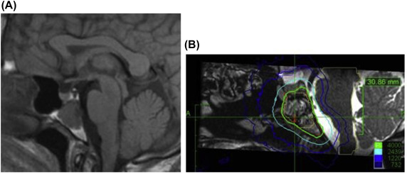 Surgical Management Of Chordomas And Chondrosarcomas Of The Cervical ...